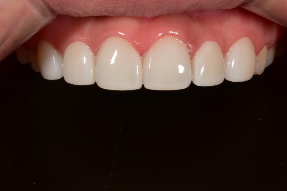 [투디치과] 블랙필름(비스포크) 치료의 다양한 사례 관련 이미지 22