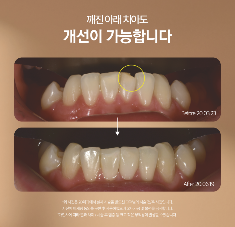 치아무삭제라미네이트 앞니크랙 이 손상 줄이면서 보완하기 관련 이미지 7
