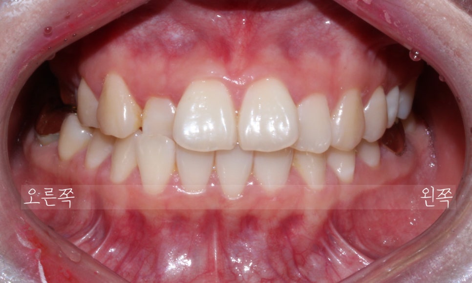 덧니 투명교정 8개월 치료 사례 관련 이미지 1