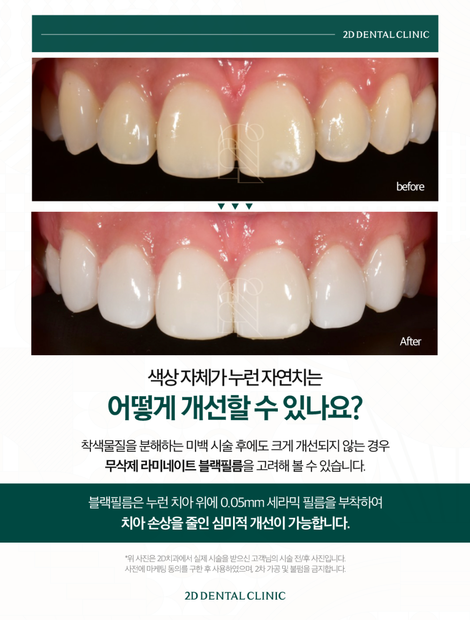 인천무삭제라미네이트 앞니치아변색 커피 먹고 누런 이 다시 하얗게 관련 이미지 4