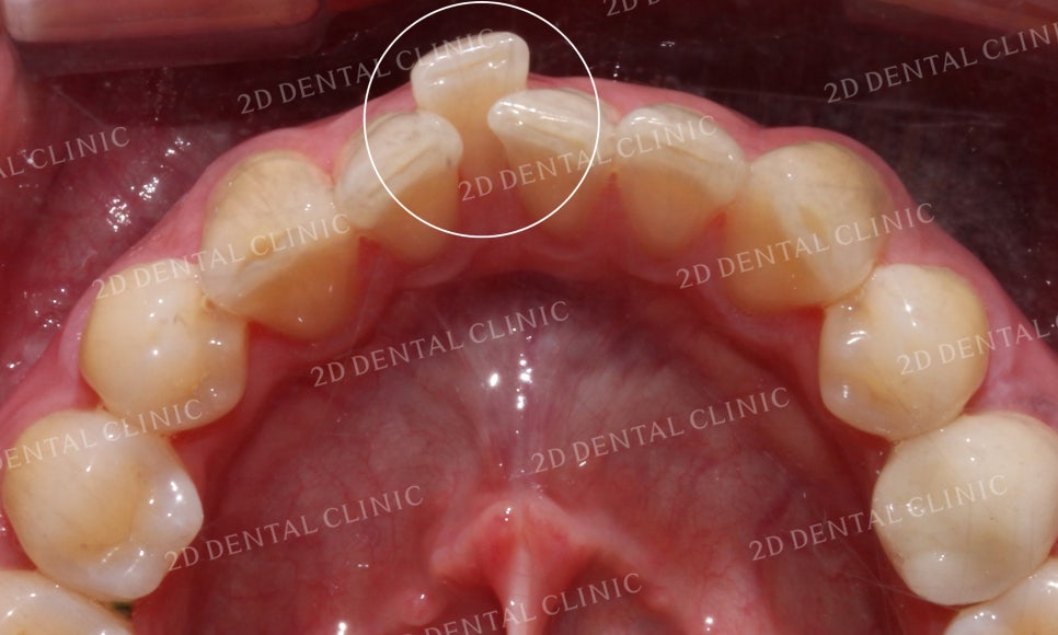 틀어진 앞니를 전체 교정으로 바르게! by.투디치과(2D치과) 관련 이미지 7