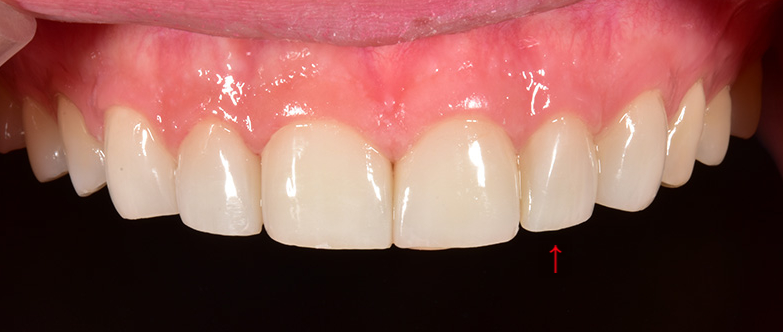 라미네이트잘하는곳 무삭제라미 블랙필름 2D치과 관련 이미지 6