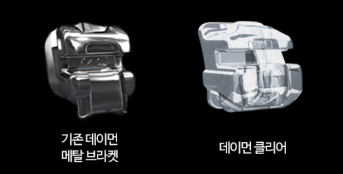 [투디(2D)치과] 데이먼 클리어 교정에 대해 알아보자! 관련 이미지 4