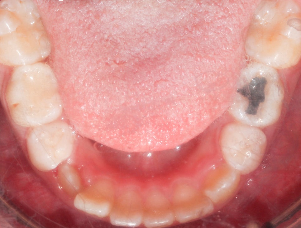 어린이 반대교합 덧니 교정으로 교정 끝! by. 투디치과(2D치과) 관련 이미지 9