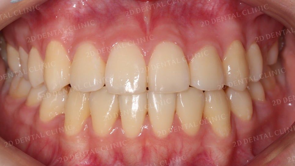 덧니치아교정, 클리피씨 전체교정으로 완벽하게! by.투디치과(2D치과) 관련 이미지 7