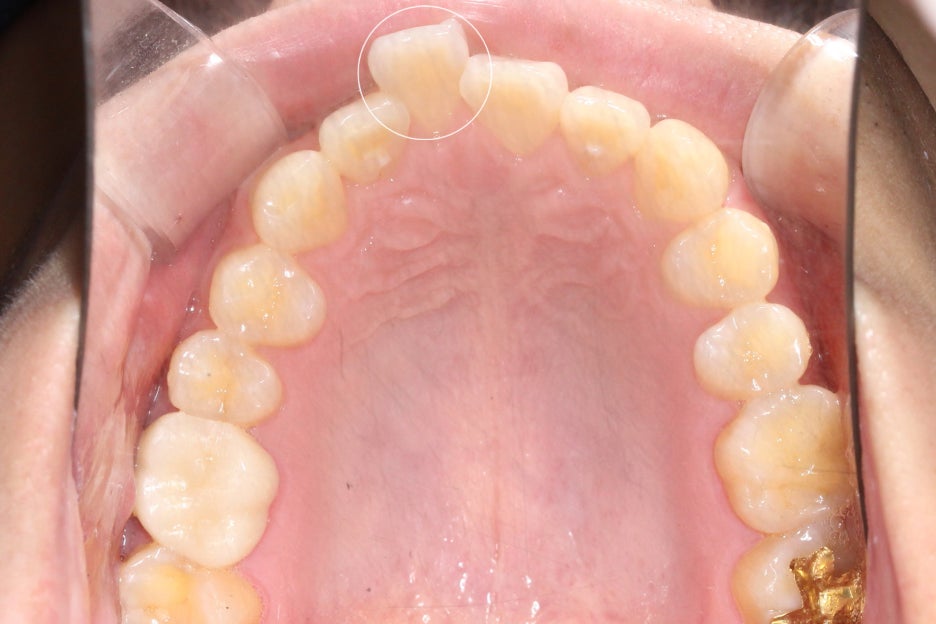 논현동치과 윗니부분교정 후기 관련 이미지 6