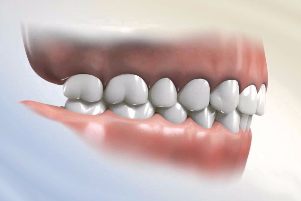 과개교합 케이스도 2D치과에서 해결! 관련 이미지 3