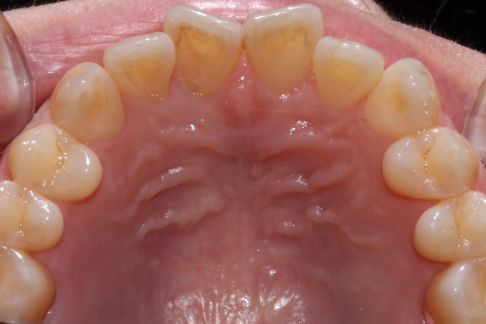 나비치아 교정 케이스 전후비교, 교정전문 2D치과 관련 이미지 5