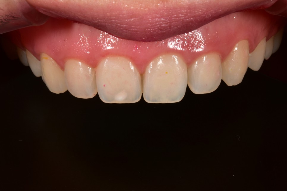 [투디치과] 블랙필름(비스포크) 치료의 다양한 사례 관련 이미지 6