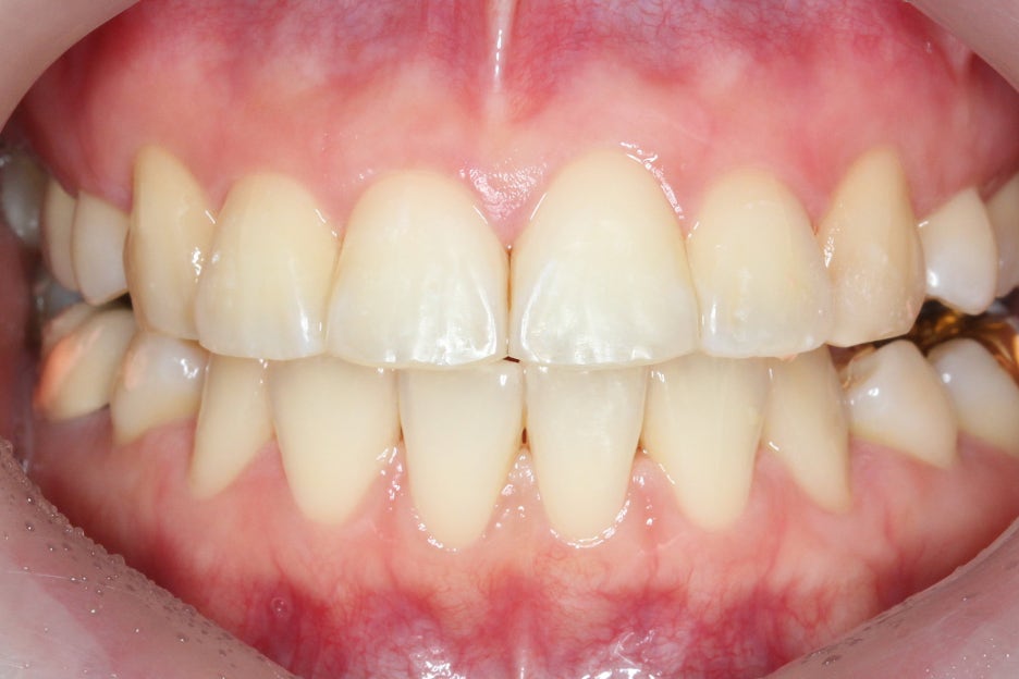 토끼앞니교정 부분교정으로 단기완성 관련 이미지 7