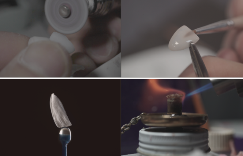 앞니라미네이트 가격 비용과 시술정보 관련 이미지 7