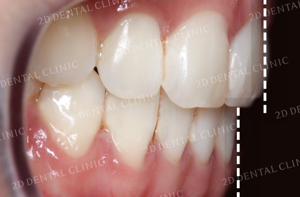 비대칭 앞니, 돌출앞니를 전체 교정으로 교정하고 싶다면!? by.투디치과(2D치과) 관련 이미지 22