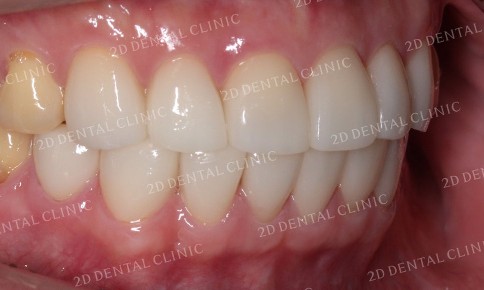 누렇고 손상된 치아를 밝고 가지런하게! by. 투디치과(2D치과)_블링스 시술후기 관련 이미지 8