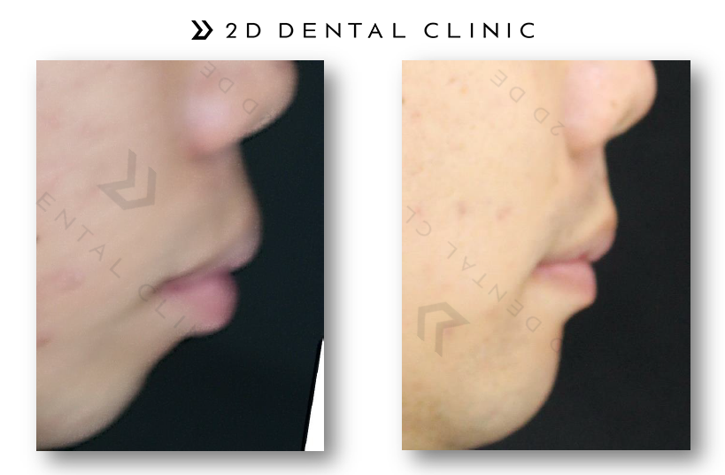 돌출입, 클리피씨로 교정기간과 통증을 최소화! 관련 이미지 3