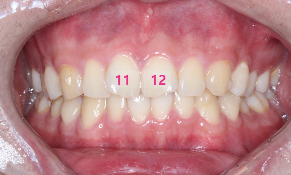 나비치아교정! 15개월만에 빠른 교정 by.투디치과(2D치과) 관련 이미지 5