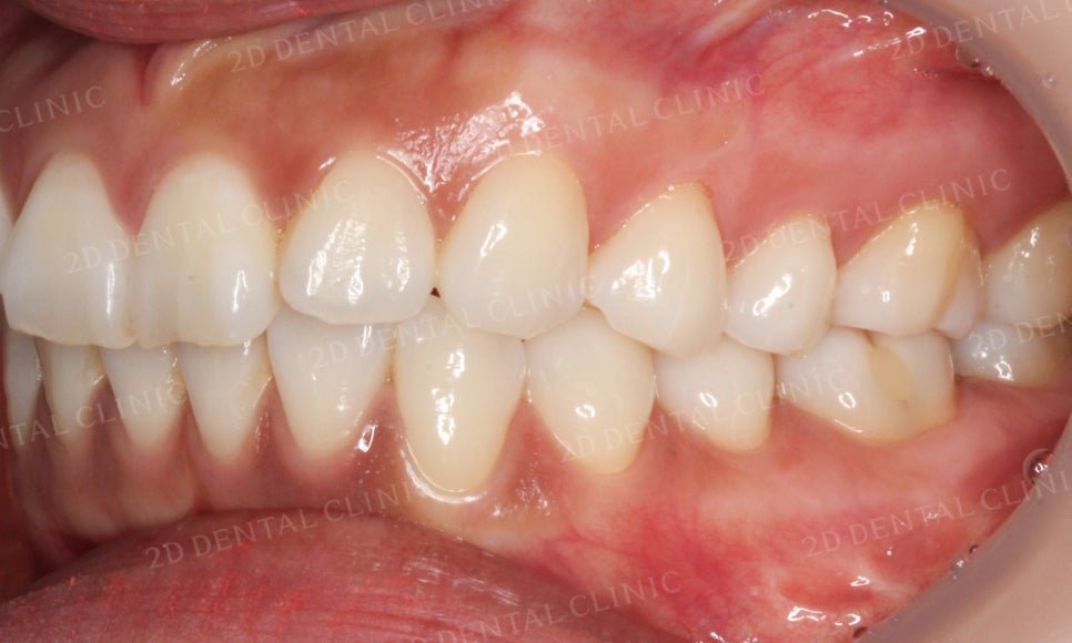 [부분교정] 틀어진 앞니, 부분교정으로 앞니교정하기! by.투디치과(2D치과) 관련 이미지 7