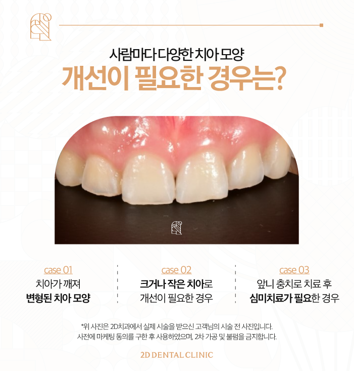 인위적인 치아 개선은 NO! 블랙필름 무삭제라미네이트 관련 이미지 3