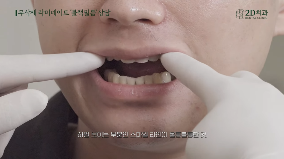 [블랙필름 상담 받고 왔어요] #4 크라운 위에 블랙필름 가능한가요? 관련 이미지 10