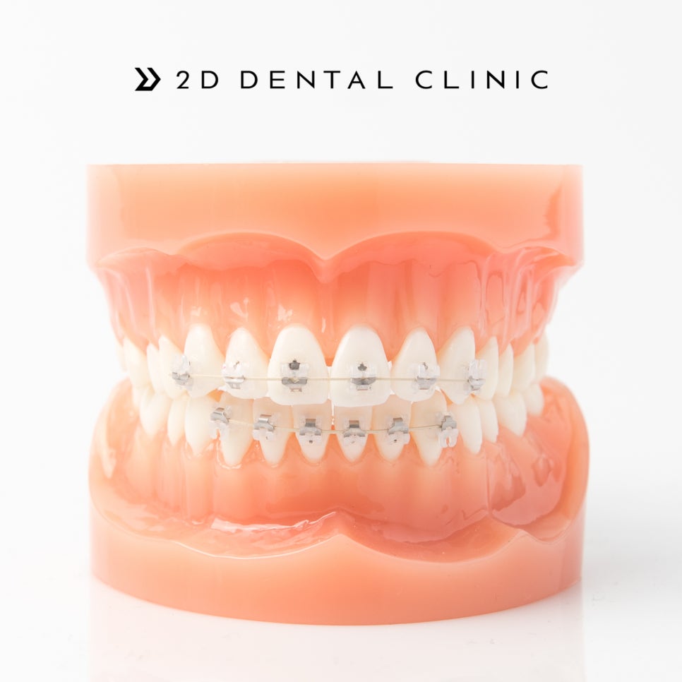 [투디(2D)치과] 치아교정에 화이트 와이어를 선택하는 이유? 관련 이미지 1