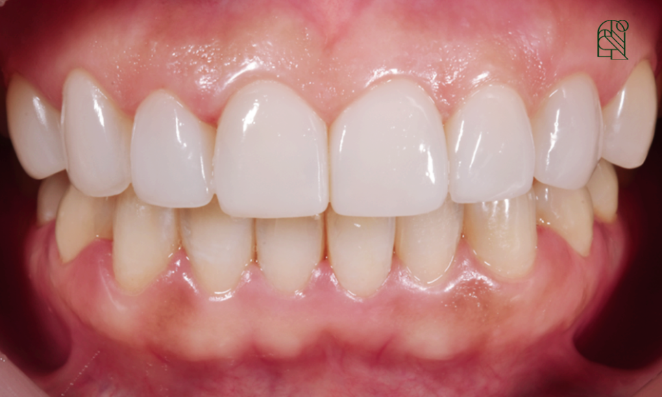 벌어진 앞니, 앞니벌어짐(diastema) 치료 - 레진, 교정, 라미네이트 관련 이미지 11