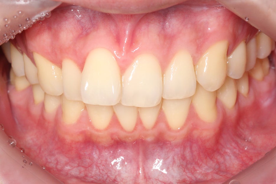 논현동치과 윗니부분교정 후기 관련 이미지 1