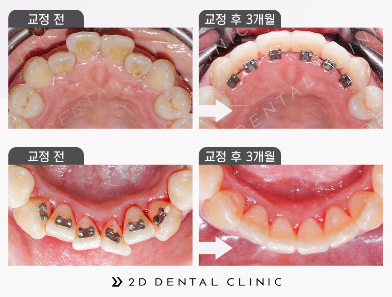 방학 기간 티 안 나게! 대학생 2D교정 추천 관련 이미지 4
