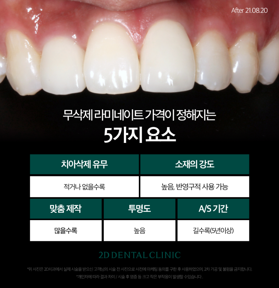 대전무삭제라미네이트 치아부분변색 전후 차이와 비용까지! 관련 이미지 4