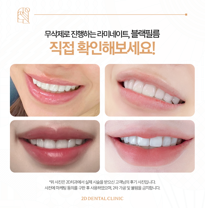 인위적인 치아 개선은 NO! 블랙필름 무삭제라미네이트 관련 이미지 6