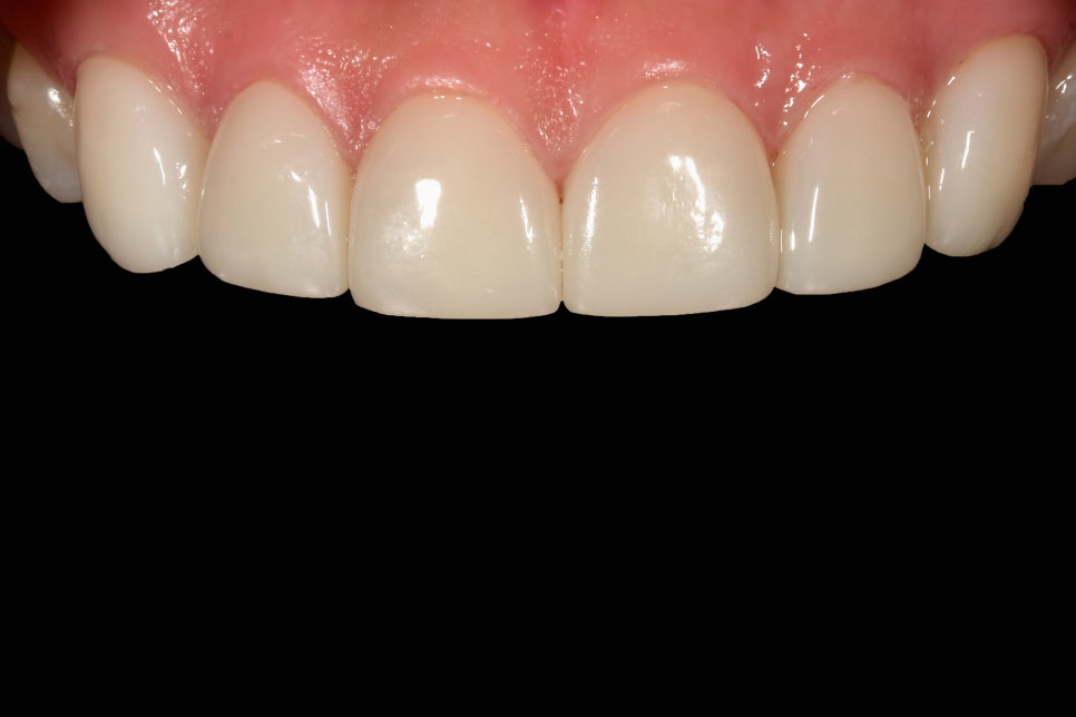 연예인라미네이트 무삭제로 잘하는 2D치과 관련 이미지 8