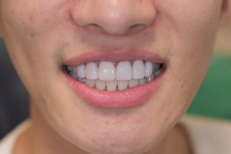 라미네이트치과 알아본다면? 관련 이미지 4