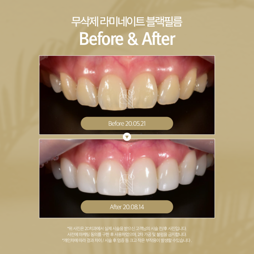 인천무삭제라미네이트 치아착색 화사한 이로 깨끗한 인상을 주고 싶을 때 관련 이미지 8
