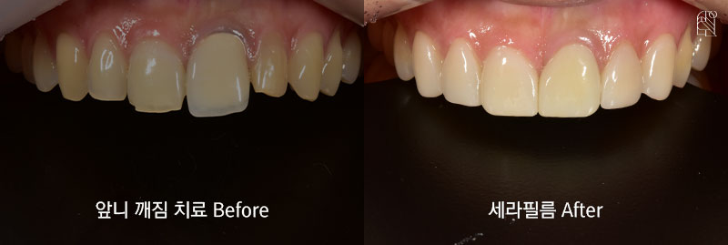앞니가 깨졌을 때 치료방법은? 관련 이미지 7