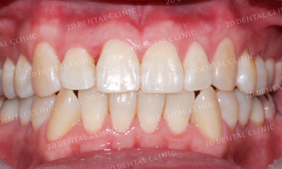 [앞니교정]부정교합교정, 부분교정으로 완성하기! by.투디치과(2D치과) 관련 이미지 14