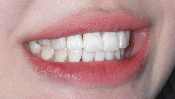 2D치과 2D교정으로 4개월만에 덧니 개선! 관련 이미지 11
