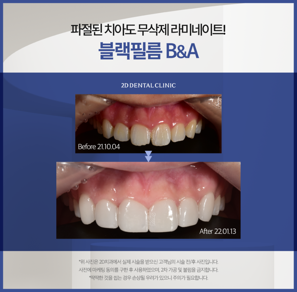 무삭제라미네이트가격 치아파절치료 깨진 이 개선 방법은? 관련 이미지 6