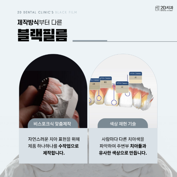 "이건 몰랐지?" 프리미엄 앞니 라미네이트 <블랙필름> 관련 이미지 4