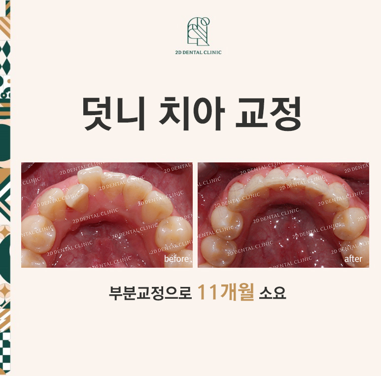 [투디교정] 덧니치아교정, 부분교정으로 쉽고 빠르게! by.투디치과(2D치과) 관련 이미지 1