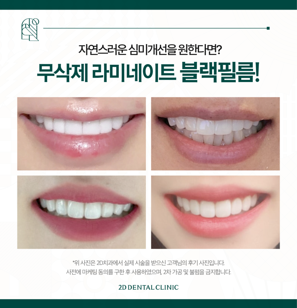 무삭제라미네이트가격 앞니변색도 개선 가능한 이유는? 관련 이미지 7