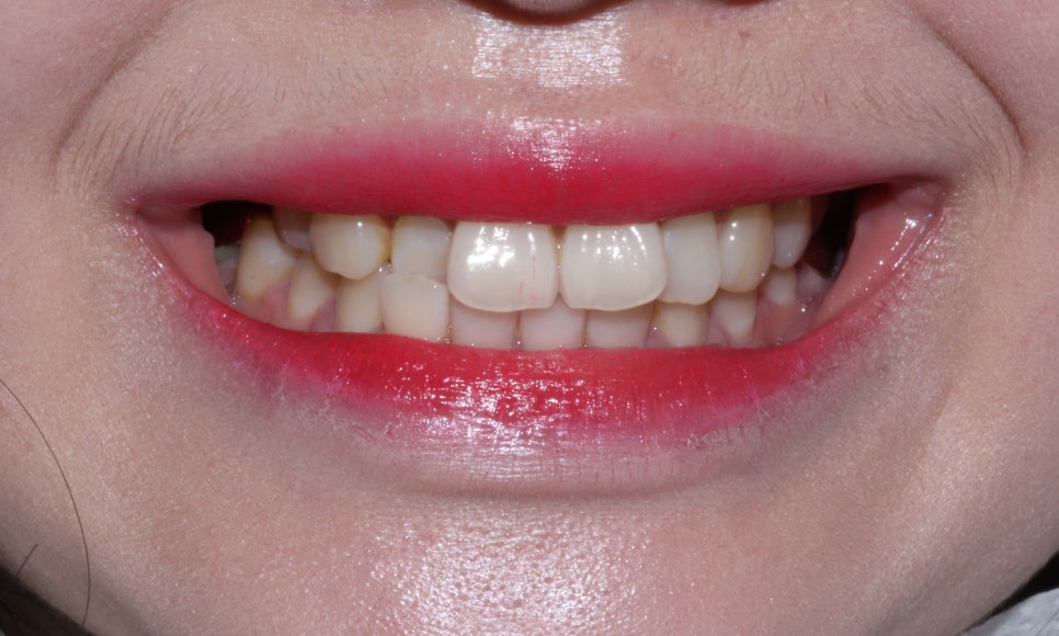 덧니 투명교정 8개월 치료 사례 관련 이미지 3