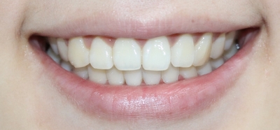 부분교정으로 5개월만에 예뻐졌어요*^_^* 관련 이미지 2