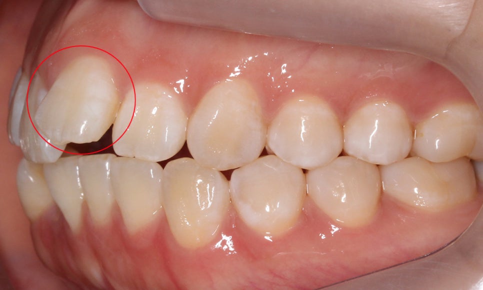 앞니돌출 급속교정 Case feat. 2D교정 관련 이미지 5