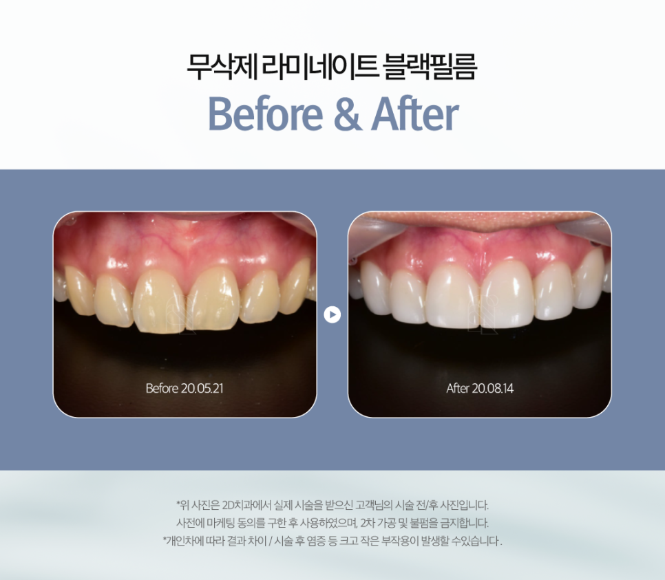 광주무삭제라미네이트 앞니파절 변색 개선 블랙필름의 시작 관련 이미지 7