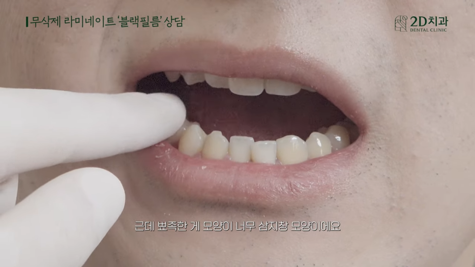 [블랙필름 상담받고 왔어요] #2 반대교합도 가능할까요? 관련 이미지 18