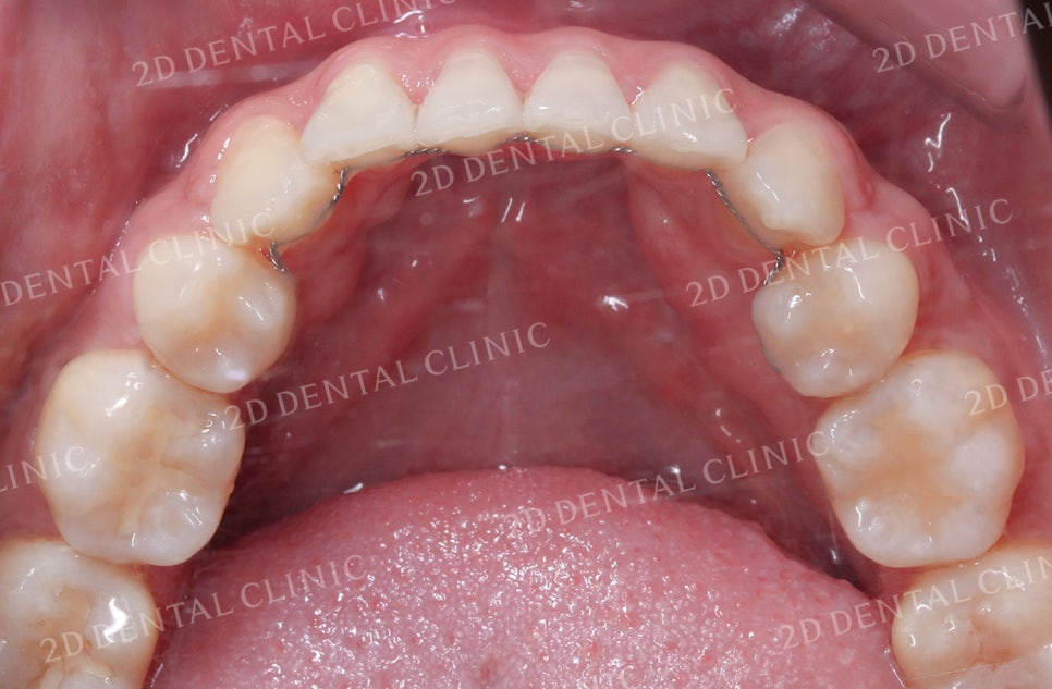 비대칭 앞니, 돌출앞니를 전체 교정으로 교정하고 싶다면!? by.투디치과(2D치과) 관련 이미지 16