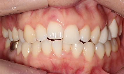 앞니틀어짐 부분교정 완성 후기 관련 이미지 1