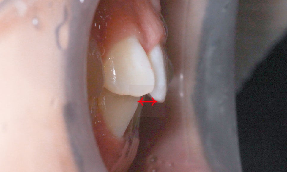 세라믹교정 앞니틀어짐 교정 사례 관련 이미지 4