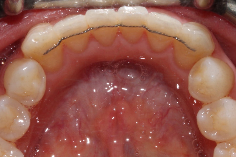 왜소치 뻐드렁니 교정 신논현역치과에서 관련 이미지 14