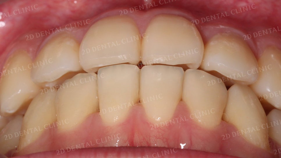 덧니치아교정, 클리피씨 전체교정으로 완벽하게! by.투디치과(2D치과) 관련 이미지 9