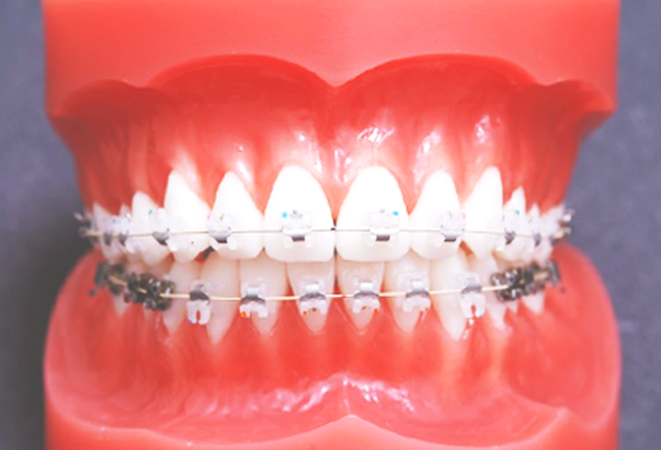 돌출입, 클리피씨로 교정기간과 통증을 최소화! 관련 이미지 6