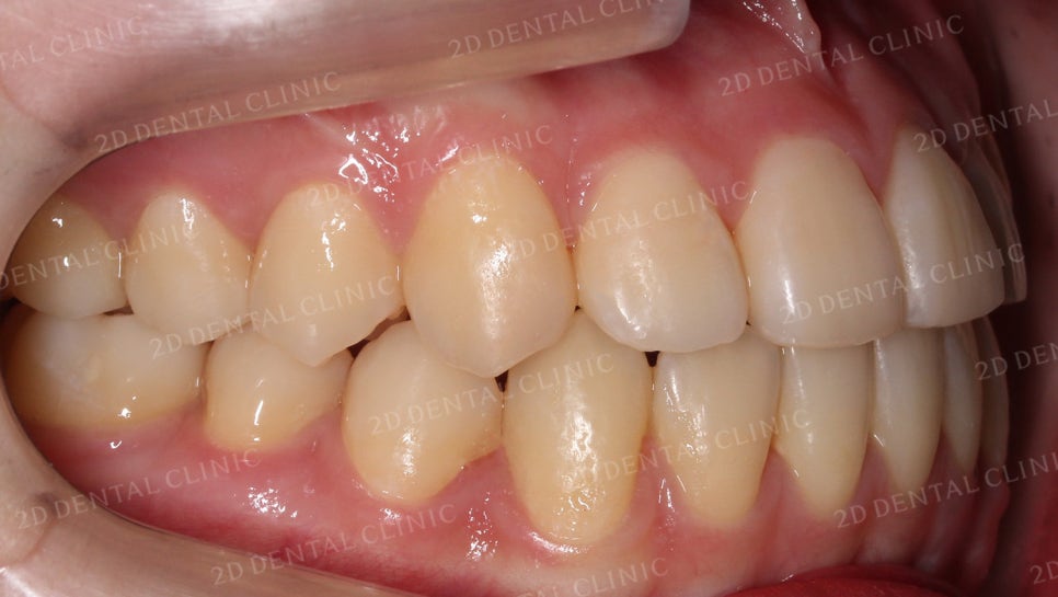 덧니치아교정, 클리피씨 전체교정으로 완벽하게! by.투디치과(2D치과) 관련 이미지 13